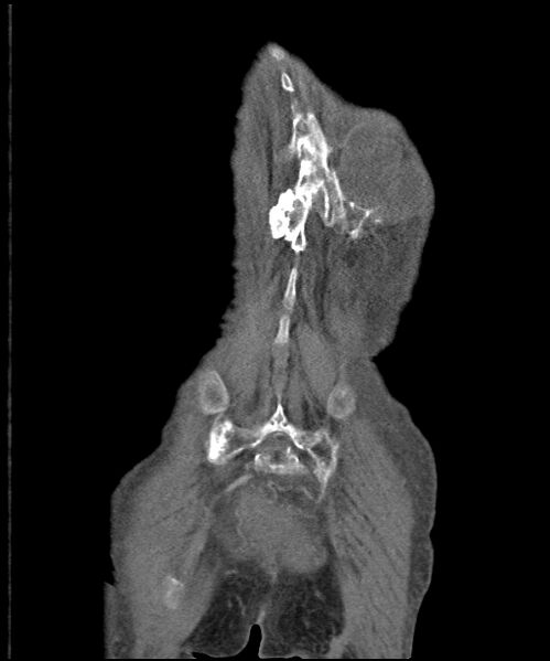 File:Chondrosarcoma of the spine (Radiopaedia 49871-55143 B 3).jpg