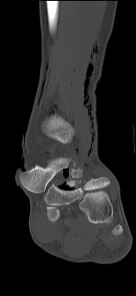 File:Chopart fracture (Radiopaedia 35347-36851 Coronal bone window 41).jpg