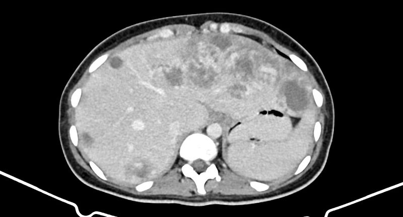 File:Choriocarcinoma liver metastases (Radiopaedia 74768-85766 A 46).jpg