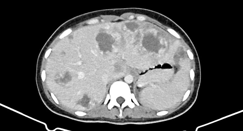 File:Choriocarcinoma liver metastases (Radiopaedia 74768-85766 A 51).jpg