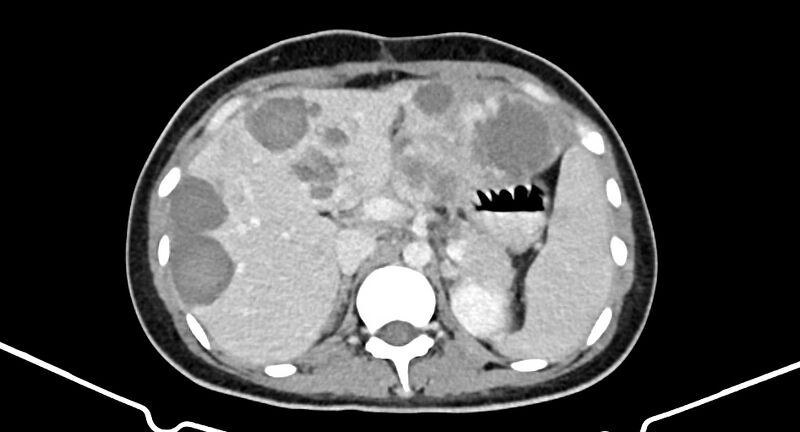 File:Choriocarcinoma liver metastases (Radiopaedia 74768-85766 A 71).jpg