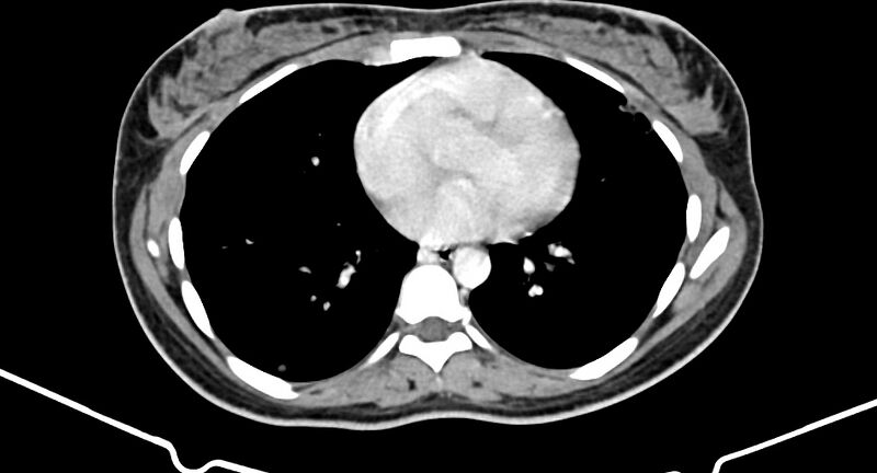 File:Choriocarcinoma liver metastases (Radiopaedia 74768-85766 A 8).jpg
