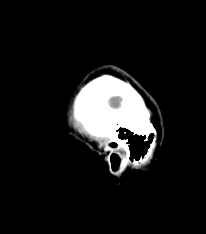 Choroid plexus carcinoma (Radiopaedia 91013-108552 B 68).jpg