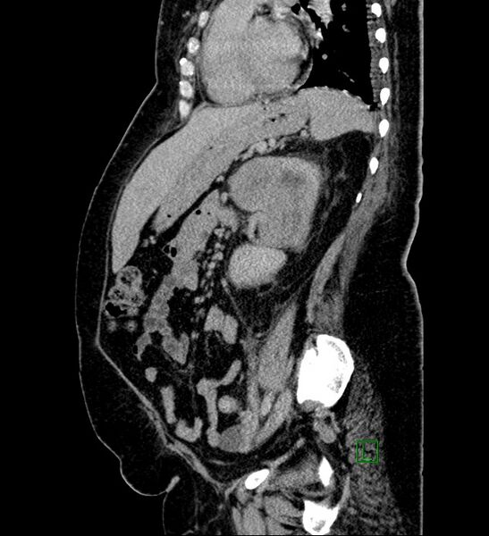File:Chromophobe renal cell carcinoma (Radiopaedia 84239-99519 G 45).jpg