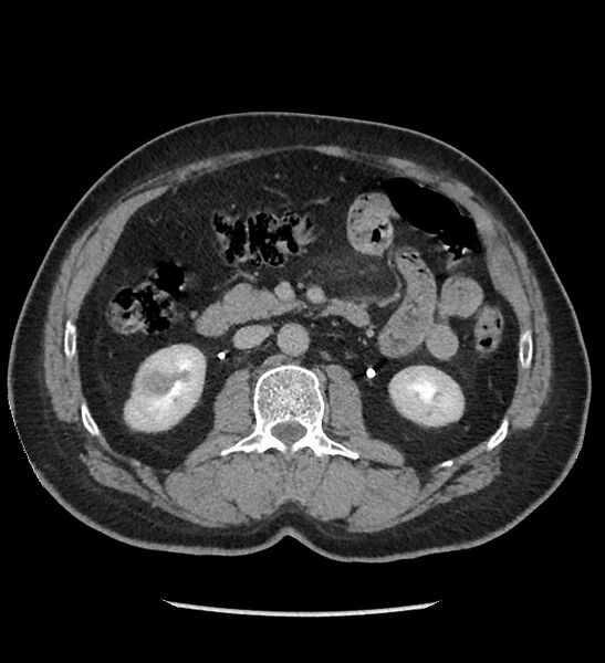 File:Chromophobe renal cell carcinoma (Radiopaedia 86879-103083 D 64).jpg