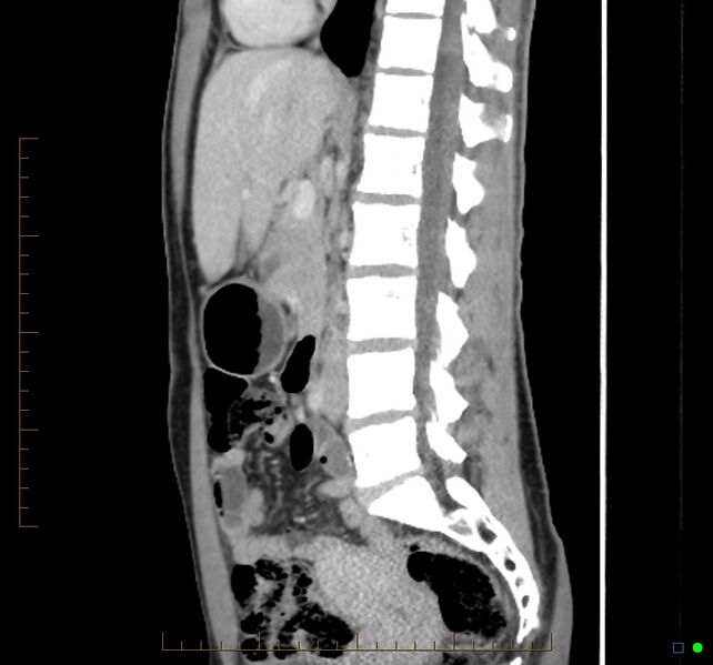 File:Chronic abscess due to "dropped" appendicoliths following appendectomy for perforated appendix (Radiopaedia 58805-66344 D 30).jpg