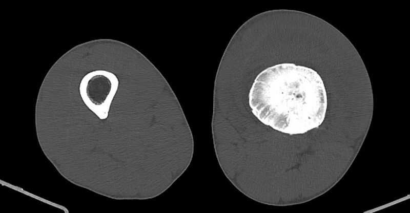File:Chronic osteomyelitis (with sequestrum) (Radiopaedia 74813-85822 Axial 38).jpg