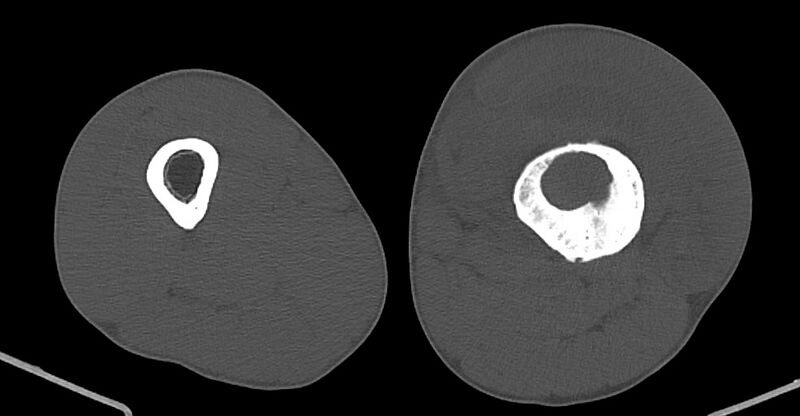 File:Chronic osteomyelitis (with sequestrum) (Radiopaedia 74813-85822 Axial non-contrast 113).jpg