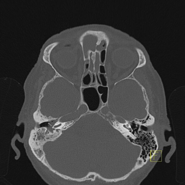File:Chronic otitis media (Radiopaedia 14994-14912 Axial bone window 12).JPEG