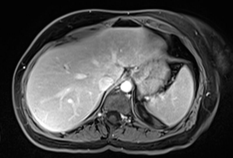File:Chronic pancreatitis - pancreatic duct calculi (Radiopaedia 71818-82250 Axial T1 C+ fat sat 12).jpg