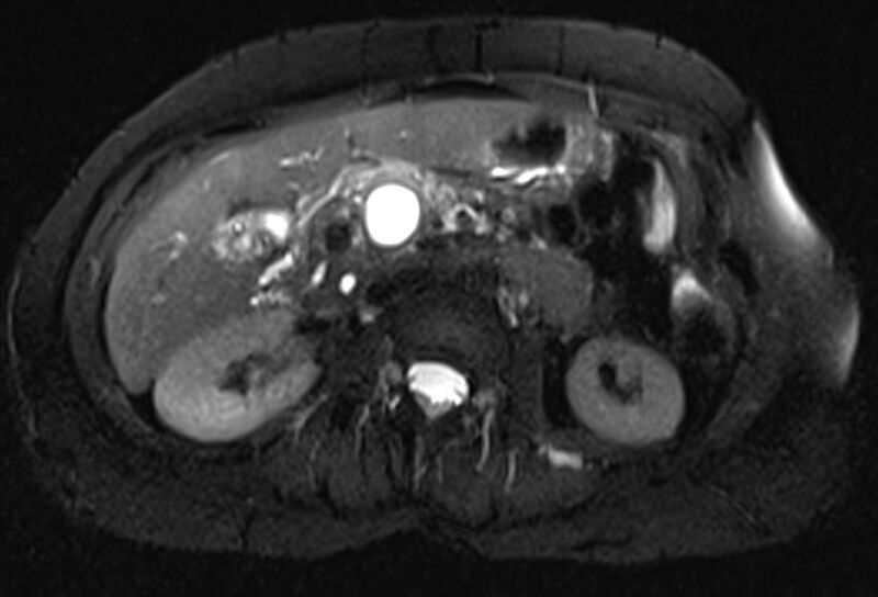 File:Chronic pancreatitis - pancreatic duct calculi (Radiopaedia 71818-82250 Axial T2 fat sat 33).jpg