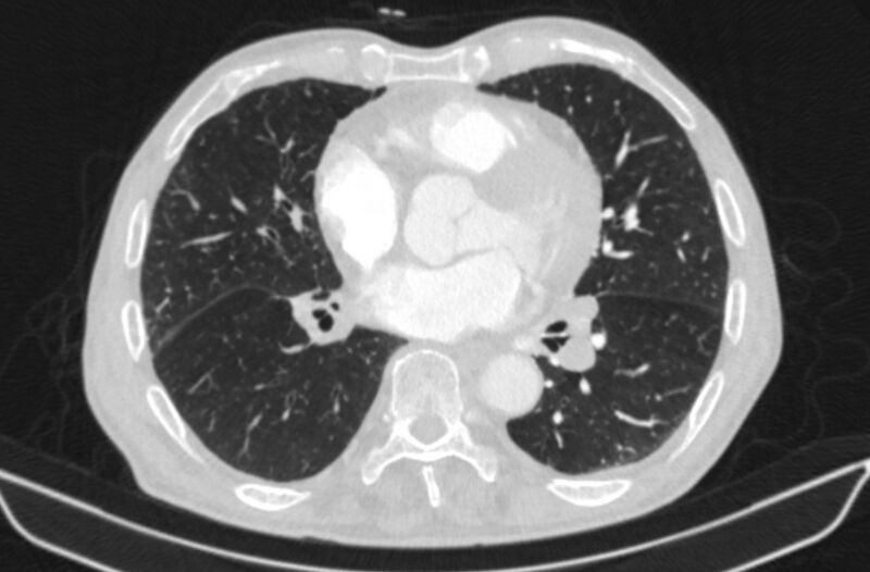File:Chronic pulmonary embolism (Radiopaedia 91241-108843 Axial lung window 55).jpg