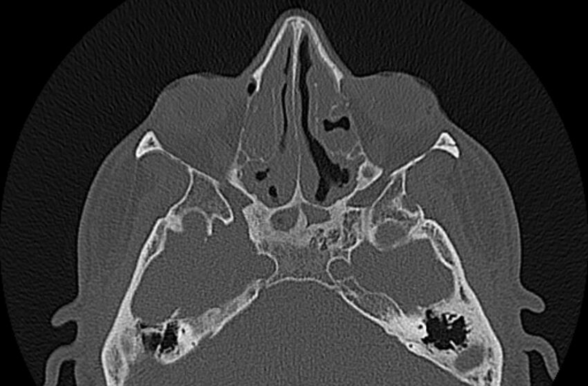 Chronic rhinosinusitis (Radiopaedia 65079-74075 Axial bone window 45).jpg