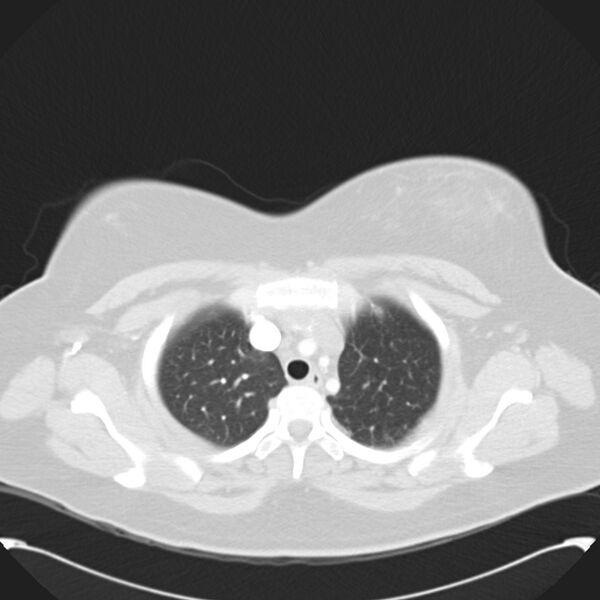 File:Chronic thromboembolic pulmonary hypertension (CTEPH) (Radiopaedia 74597-85531 Axial lung window 12).jpg