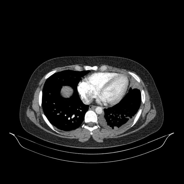 File:Chronic thromboembolic pulmonary hypertension (CTEPH) (Radiopaedia 74597-85532 Axial C+ CTPA 56).jpg