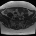 Class II Mullerian duct anomaly- unicornuate uterus with rudimentary horn and non-communicating cavity (Radiopaedia 39441-41755 Axial T1 6).jpg