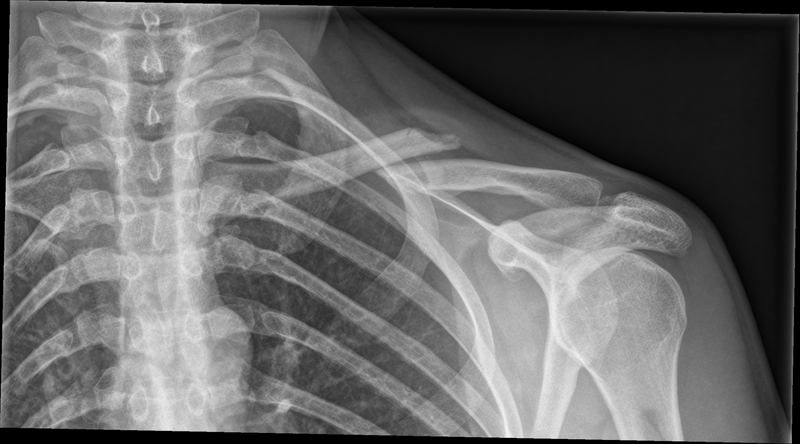File:Clavicle fracture (Radiopaedia 62007-70092 Frontal 1).png