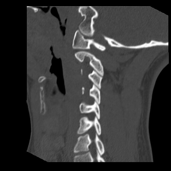 File:Clay-shoveler fracture (Radiopaedia 22568-22590 Sagittal bone window 32).jpg