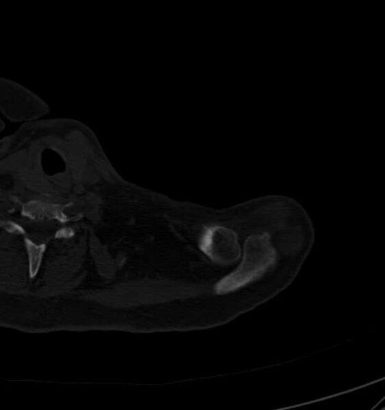 File:Clear cell chondrosarcoma - humerus (Radiopaedia 63104-71612 Axial bone window 8).jpg