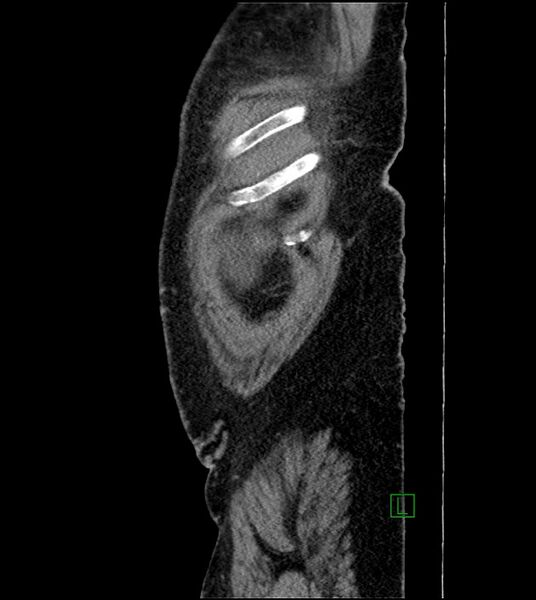 File:Closed-loop small bowel obstruction-internal hernia (Radiopaedia 78439-91096 C 132).jpg