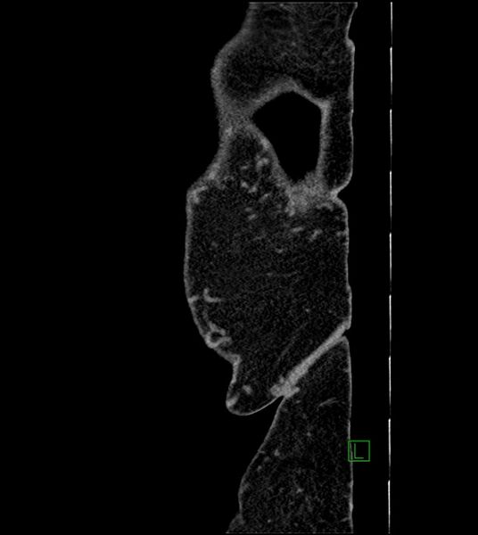 File:Closed-loop small bowel obstruction-internal hernia (Radiopaedia 78439-91096 C 8).jpg