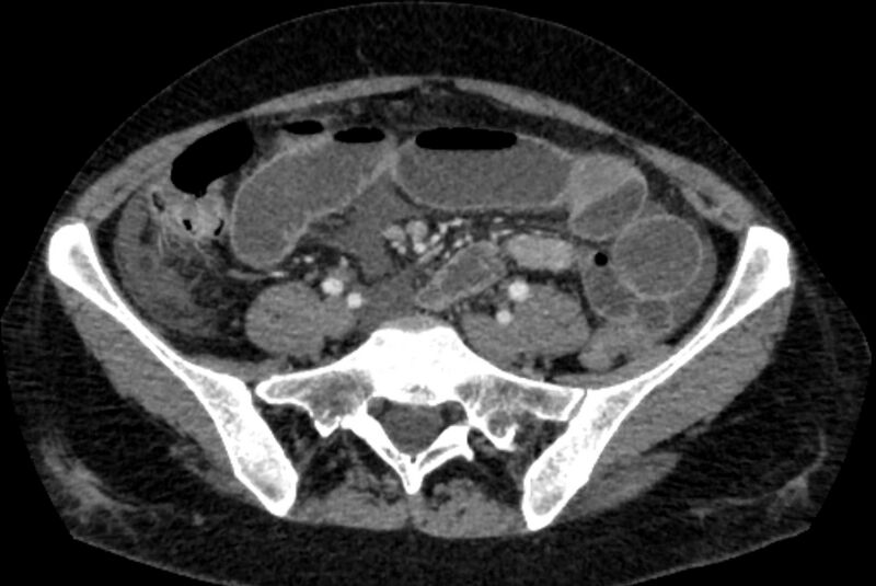 File:Closed loop small bowel obstruction (Radiopaedia 71211-81508 A 99).jpg