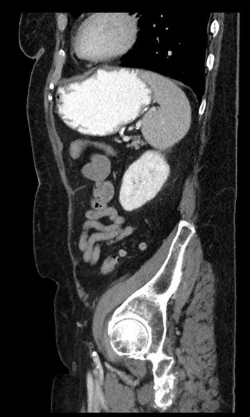 File:Closed loop small bowel obstruction - adhesions (Radiopaedia 59269-66611 C 30).jpg