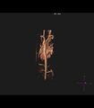 Coarctation of the aorta (Radiopaedia 43373-46729 3D reconstruction 7).jpg