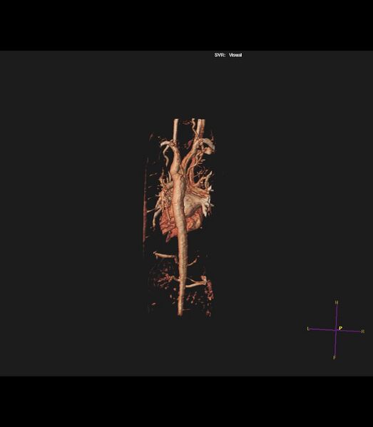 File:Coarctation of the aorta (Radiopaedia 43373-46729 3D reconstruction 7).jpg