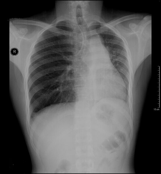 File:Coarctation of the aorta (Radiopaedia 8511-9334 Frontal 1).jpg