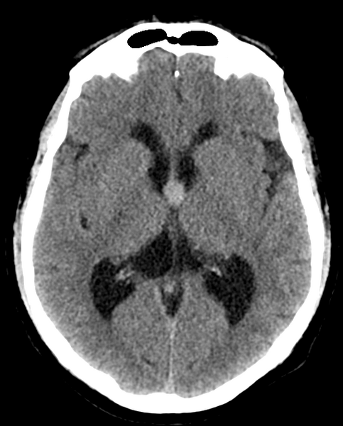 File:Colloid cyst of the third ventricle (Radiopaedia 86571-102661 Axial non-contrast 17).png