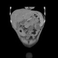 Colocolic fistula - Crohn disease (Radiopaedia 57063-63955 B 10).jpg