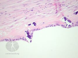 pathology-Urachal cyst