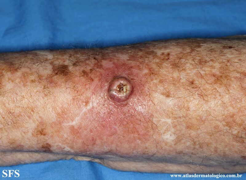 File:Keratoacanthoma (Dermatology Atlas 72).jpg