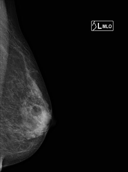 File:Lipoma of the breast (Radiopaedia 42898).jpg