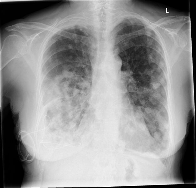 File:Lung metastases (Radiopaedia 74855).jpg