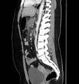 Necrotizing pancreatitis (Radiopaedia 23001-23031 C 43).jpg