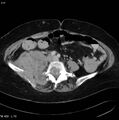 Nerve sheath tumor - malignant - sacrum (Radiopaedia 5219-6987 A 3).jpg