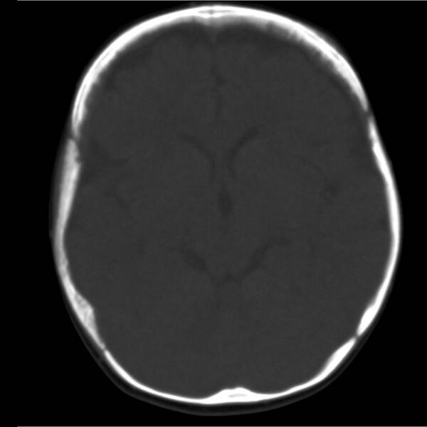 File:Neuroblastoma with skull metastases (Radiopaedia 30326-30958 Axial bone window 8).jpg