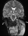 Neurofibromatosis type 1 (Radiopaedia 6954-8063 Coronal T2 7).jpg