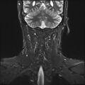 Neurofibromatosis type 1 (Radiopaedia 80355-93740 Coronal STIR 12).jpg