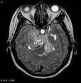 Neurofibromatosis type 2 - cranial and spinal involvement (Radiopaedia 5351-7111 Axial T2 7).jpg