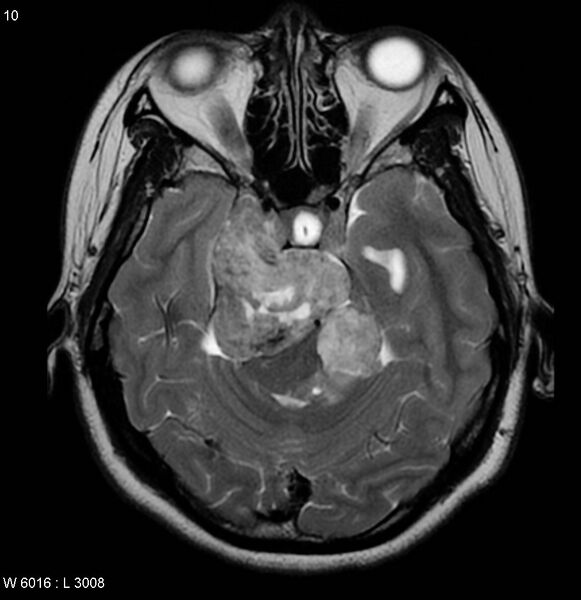 File:Neurofibromatosis type 2 - cranial and spinal involvement (Radiopaedia 5351-7111 Axial T2 7).jpg