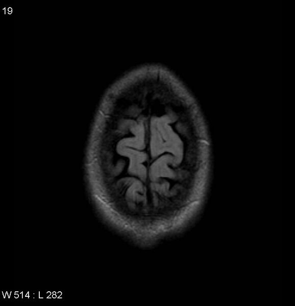 File:Neurosarcoidosis (Radiopaedia 10930-17204 Axial FLAIR 19).jpg