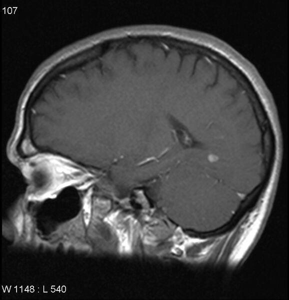 File:Neurosarcoidosis (Radiopaedia 10930-17204 Sagittal T1 C+ 12).jpg