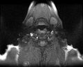 Non-Hodgkin lymphoma - parotid gland (Radiopaedia 71531-81890 T1 fat sat 3).jpg