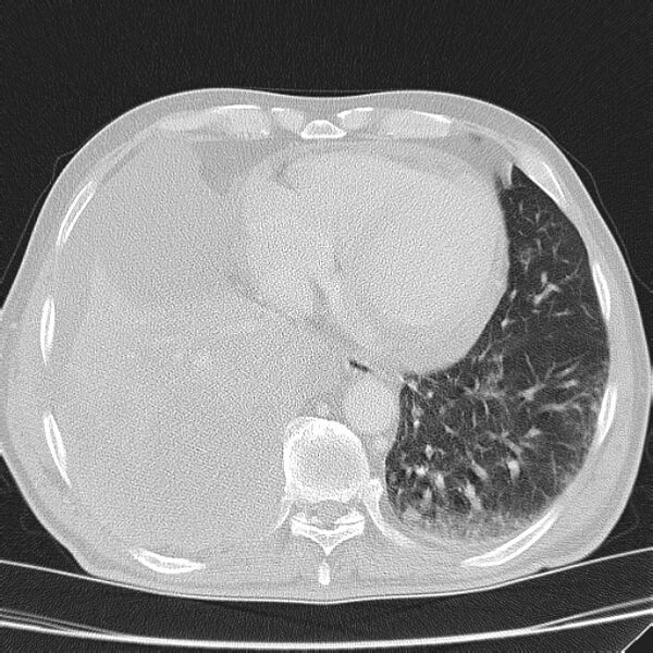 File:Non small-cell lung cancer (Radiopaedia 24467-24769 lung window 39).jpg