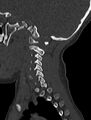 Normal CT cervical spine - pediatric (Radiopaedia 52549-58462 Sagittal bone window 164).jpg