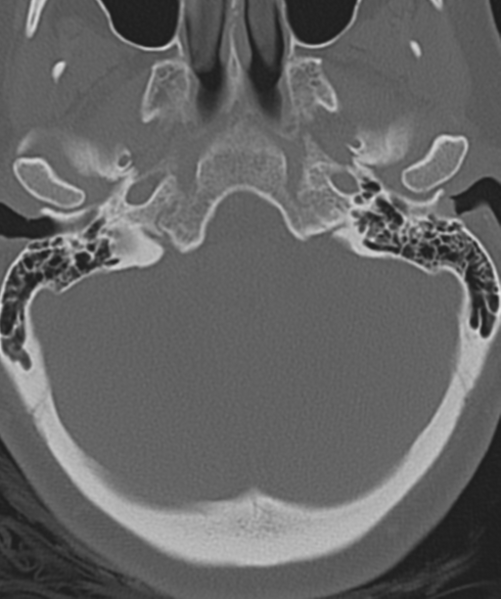 File:Normal cervical spine MRI (including Dixon) (Radiopaedia 42762-45926 Axial bone window 2).png