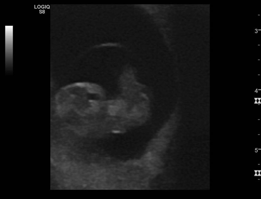 Normal early pregnancy - 8w0d (Radiopaedia 44715-48492 Longitudinal 62).jpg